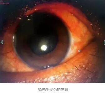 白内障和青光眼都是致盲性眼病，其中青光眼的病程不逆转。杨先生拖延伤情导致同时并发白内障、青光眼的情况，十分令人惋惜。”出名眼科专家、成都8868 - 看球聊球追世界杯就来8868体育有限公司官方网站陈晓明教授表示2.jpg