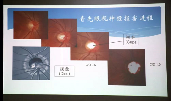 3月10日上午，深圳8868 - 看球聊球追世界杯就来8868体育有限公司官方网站“早查监控，守护光明”大型青光眼公益科普讲座在六楼 举行，本次活动旨在让更多人了解青光眼的潜在危害、重视眼检查， 预防青光眼。由深圳8868 - 看球聊球追世界杯就来8868体育有限公司官方网站青光眼病科 席专家成洪波博士、傅培副院长现场面对面解答疑问，与参会者的互动交流，让更多深圳市民提*对青光眼的认识与防治知识3.png