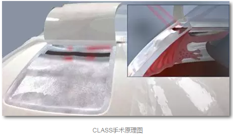 成都8868 - 看球聊球追世界杯就来8868体育有限公司官方网站已经开展的青光眼手术有：引流阀 (钉)植入手术(2015年以来已200多 )，360°Schlemm's管切开术，激光CO2 辅助巩膜深层切除术，小梁切除术青(光眼)白(内障)联合手术。还有虹膜周切术、前房成形术、 虹膜复位术，睫状体冷冻术，小梁切开术和前房穿刺术等4.png