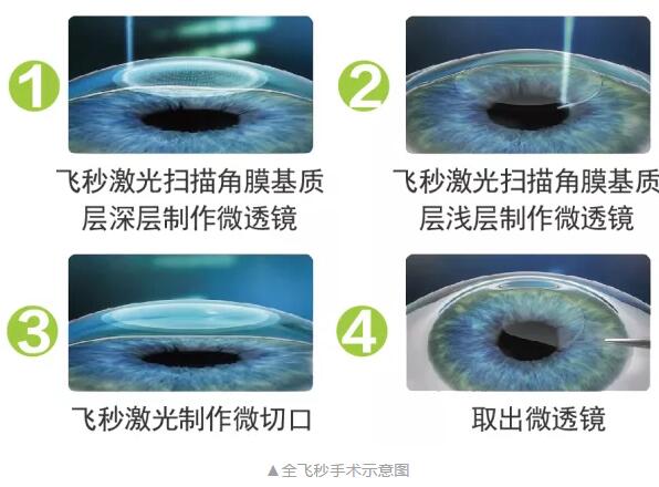 主流近视手术包含全飞秒激光手术、Smart全激光手术、半飞秒激光手术、晶体植入手术1.jpg 主流近视手术包含全飞秒激光手术、Smart全激光手术、半飞秒激光手术、晶体植入手术1.jpg