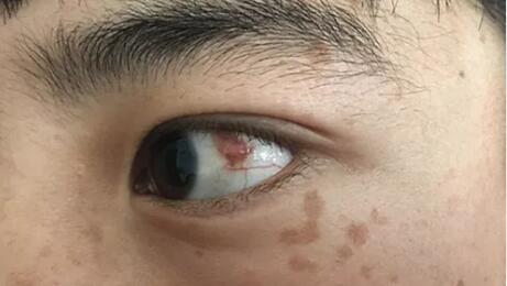 四川丹巴15岁男孩患结膜血管瘤，在成都8868 - 看球聊球追世界杯就来8868体育有限公司官方网站顺利手术1.jpg