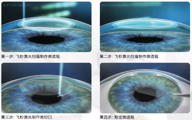 2020高考视力受限专业有哪些？来听听8868体育近视手术医生的建议1.png